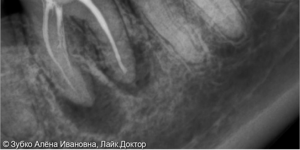 Лечение хронического периодонтита 36 зуба - фото №1