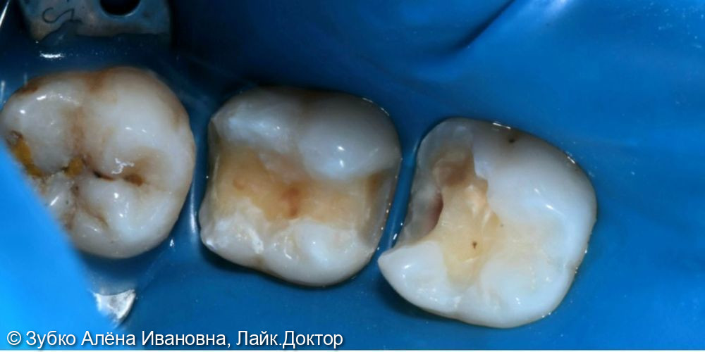 Лечение кариеса 37 и 36го зуба - фото №1