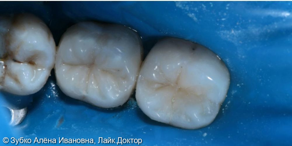 Лечение кариеса 37 и 36го зуба - фото №2