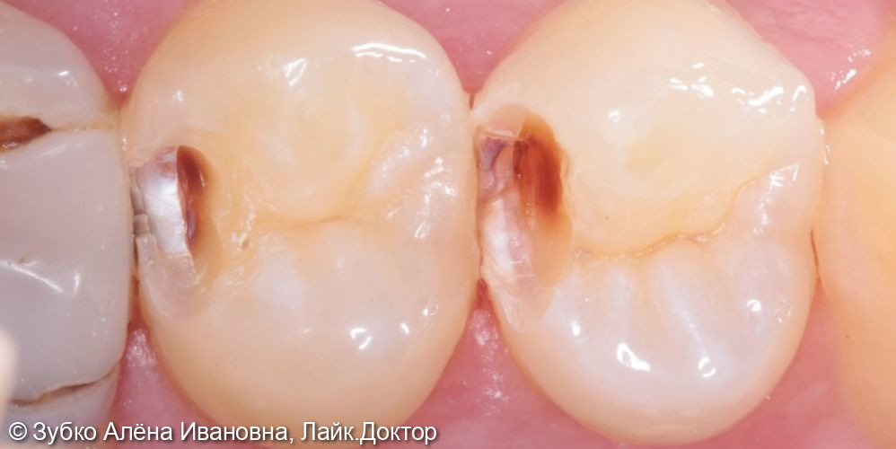 Лечение кариес 24 и 25го зуба - фото №2