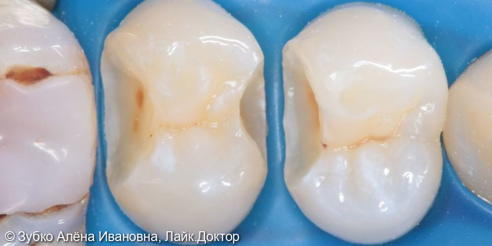 Лечение кариес 24 и 25го зуба - фото №3