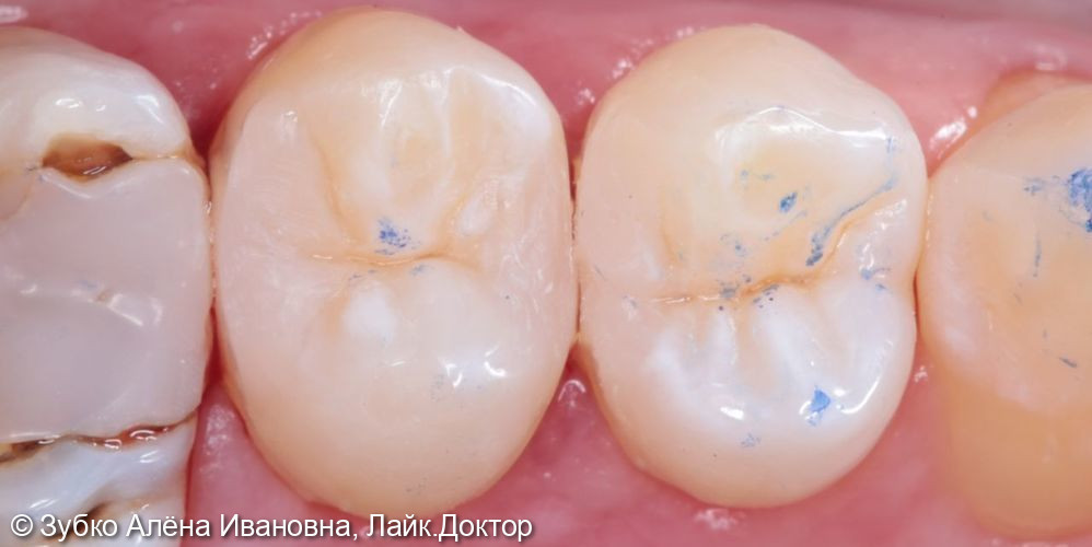 Лечение кариес 24 и 25го зуба - фото №4