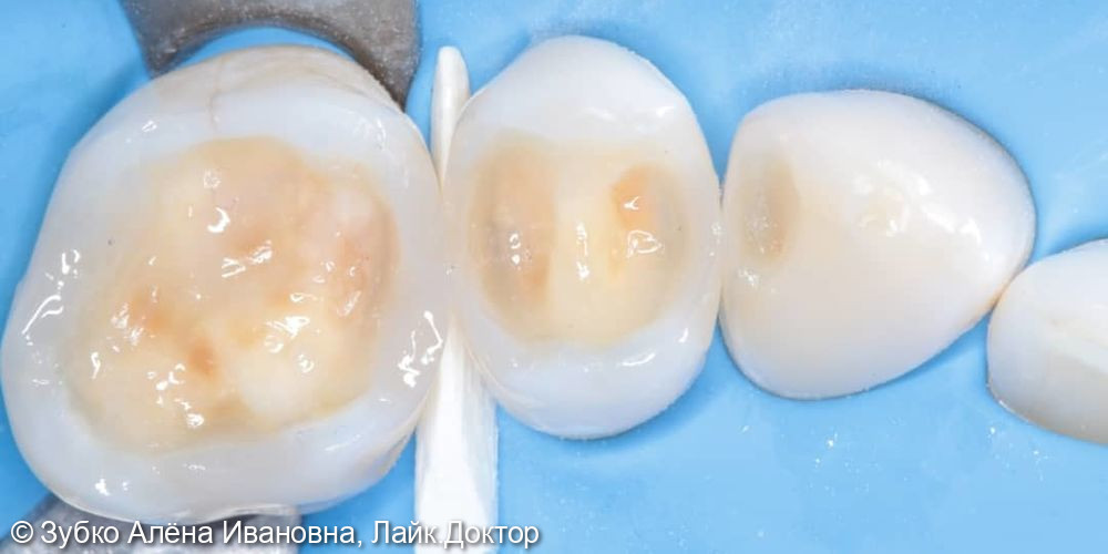 Лечение кариеса 23, 25, 26го зубов - фото №4