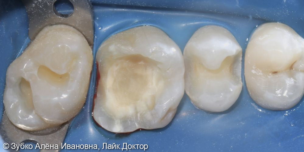 Лечение глубокого кариеса 25,26,27го зубов - фото №2