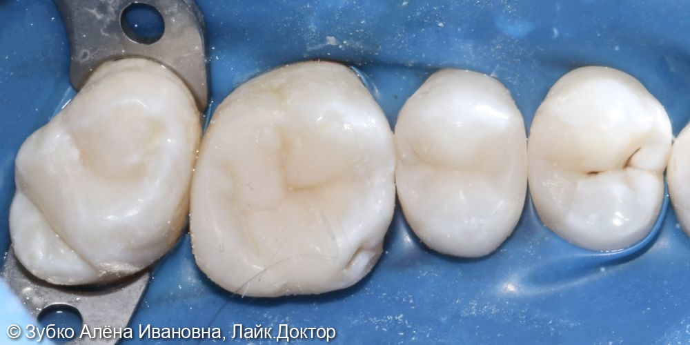 Лечение глубокого кариеса 25,26,27го зубов - фото №3