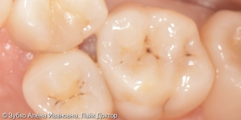 Лечение 4х зубов (кариесы 15. 14 и 17го зуба и хр пульпит 16го) - фото №1