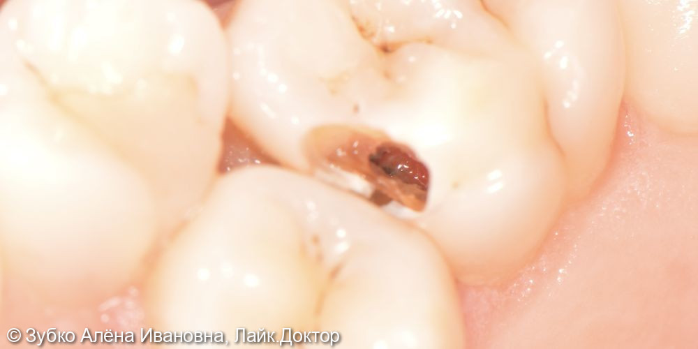 Лечение 4х зубов (кариесы 15. 14 и 17го зуба и хр пульпит 16го) - фото №2