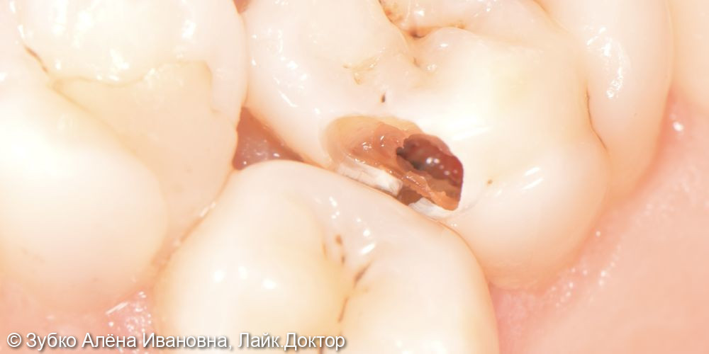 Лечение 4х зубов (кариесы 15. 14 и 17го зуба и хр пульпит 16го) - фото №3