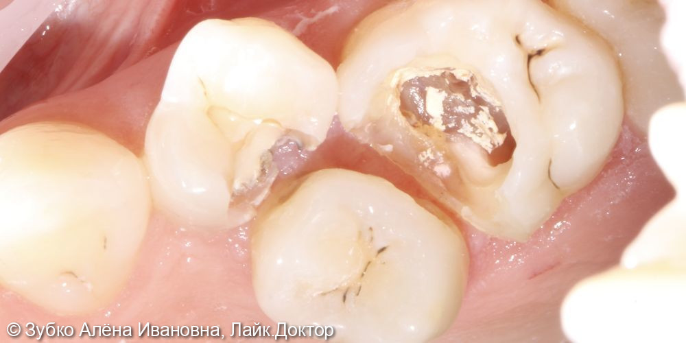 Лечение 4х зубов (кариесы 15. 14 и 17го зуба и хр пульпит 16го) - фото №4