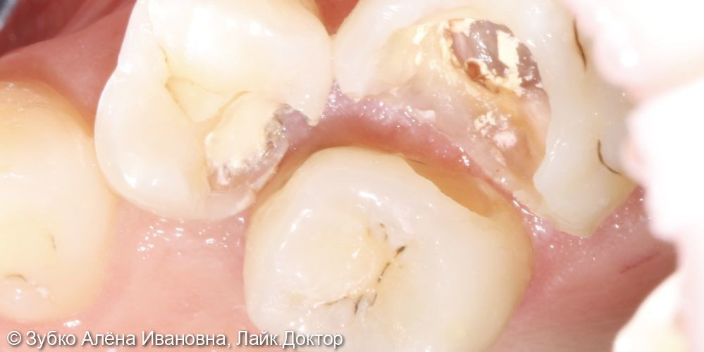 Лечение 4х зубов (кариесы 15. 14 и 17го зуба и хр пульпит 16го) - фото №5