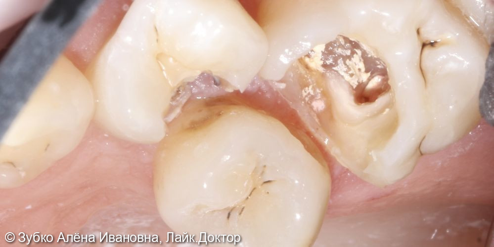 Лечение 4х зубов (кариесы 15. 14 и 17го зуба и хр пульпит 16го) - фото №6