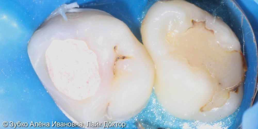 Лечение 4х зубов (кариесы 15. 14 и 17го зуба и хр пульпит 16го) - фото №7