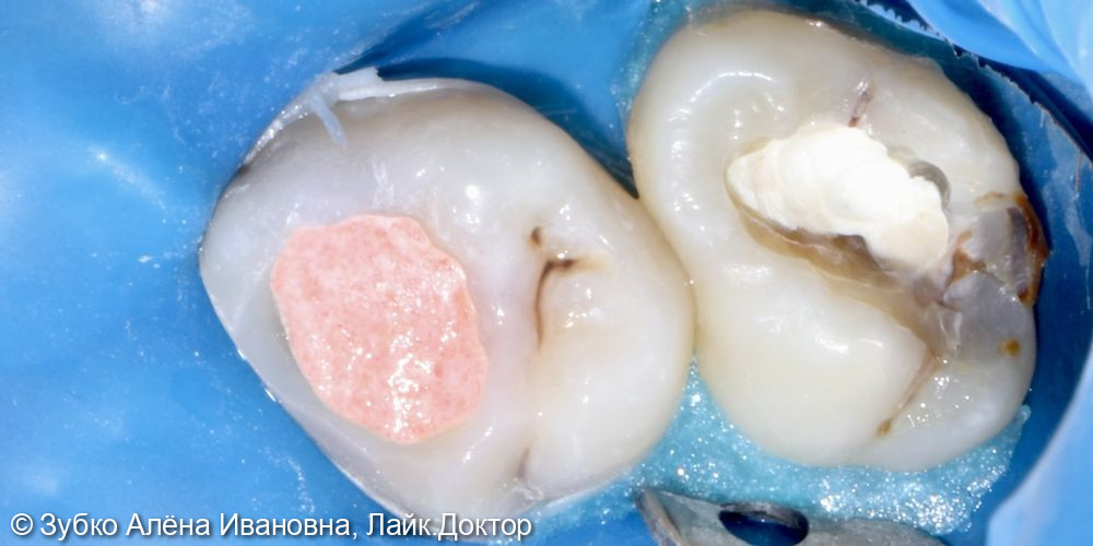 Лечение 4х зубов (кариесы 15. 14 и 17го зуба и хр пульпит 16го) - фото №8