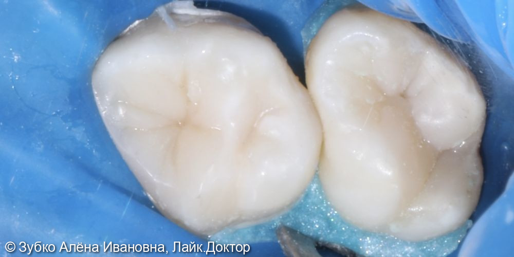 Лечение 4х зубов (кариесы 15. 14 и 17го зуба и хр пульпит 16го) - фото №10