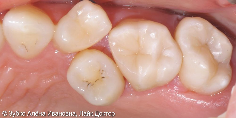 Лечение 4х зубов (кариесы 15. 14 и 17го зуба и хр пульпит 16го) - фото №11