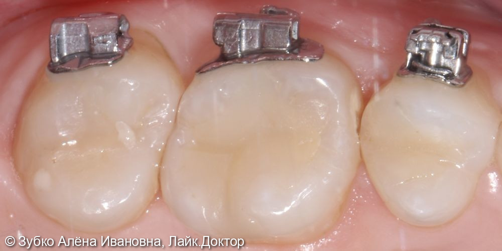 Лечение кариеса 16 и 17го зуба - фото №1