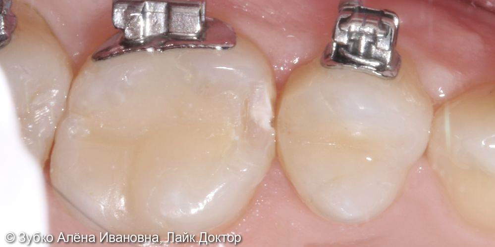 Лечение кариеса 16 и 17го зуба - фото №2