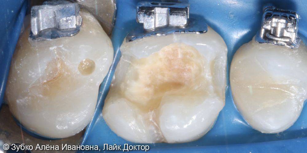 Лечение кариеса 16 и 17го зуба - фото №3