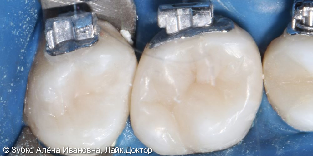 Лечение кариеса 16 и 17го зуба - фото №4