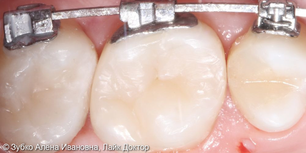 Лечение кариеса 16 и 17го зуба - фото №5