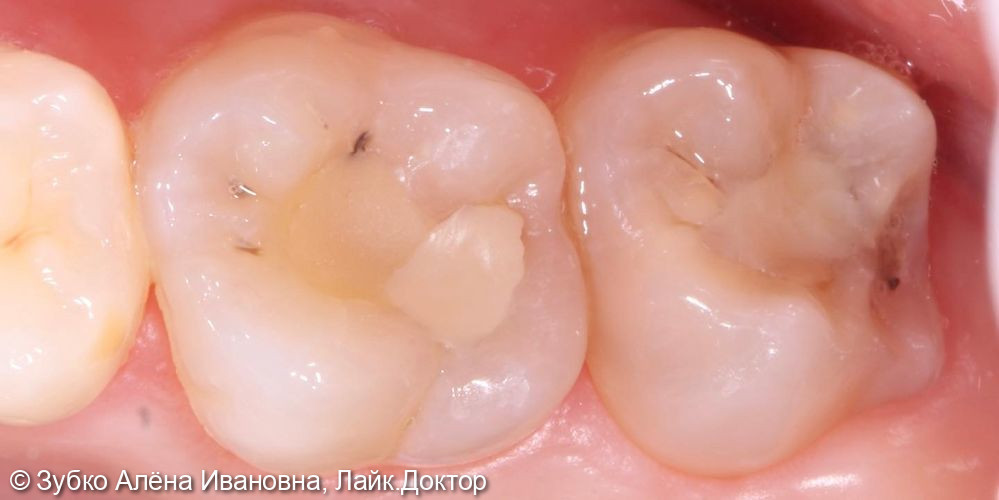 Лечение глубокого кариеса 16 и 17 зубов - фото №1