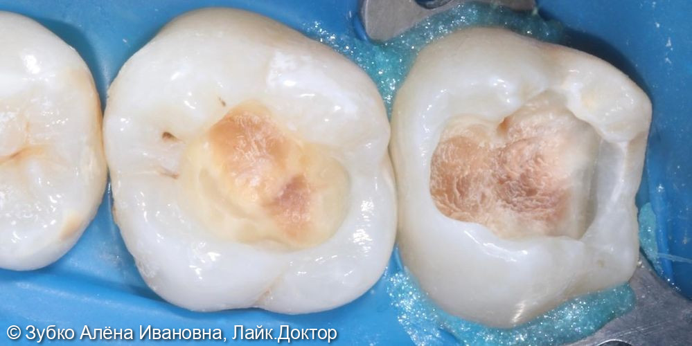 Лечение глубокого кариеса 16 и 17 зубов - фото №2