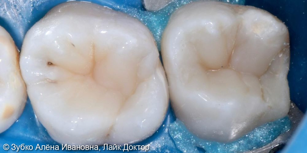 Лечение глубокого кариеса 16 и 17 зубов - фото №3