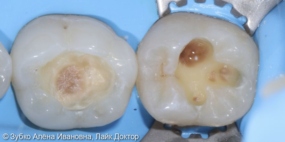 Лечение кариеса 46 и 47 зубов - фото №1