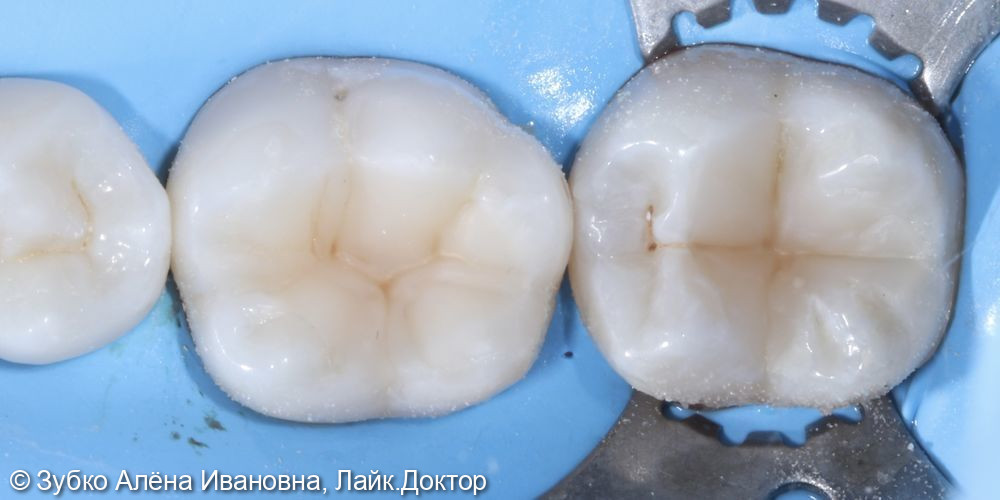 Лечение кариеса 46 и 47 зубов - фото №2