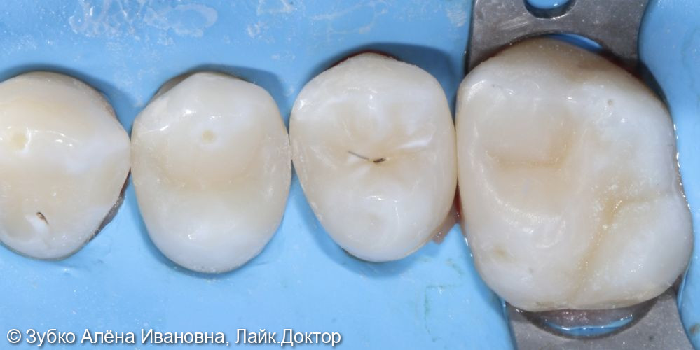 Лечение кариеса 16 15 14 13 зубов - фото №4