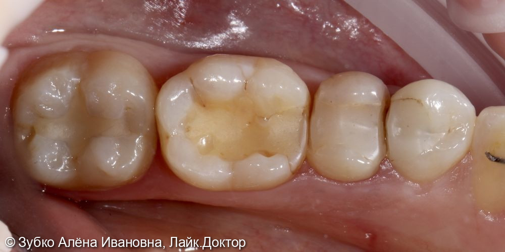 Лечение 34, 35, 36 и 37 го зуба - фото №1