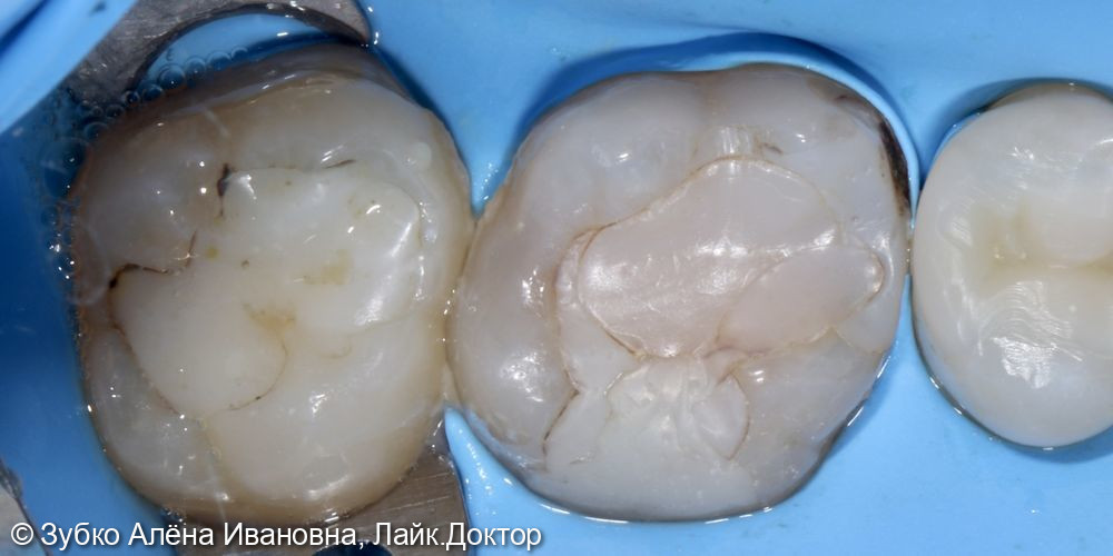 Лечение 2.6 и 2.7 зубов - фото №1