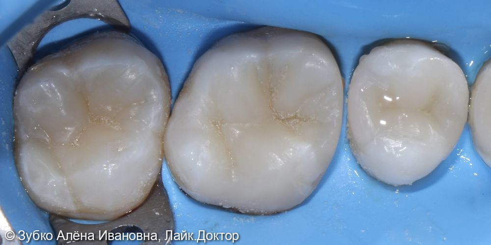 Лечение 2.6 и 2.7 зубов - фото №3
