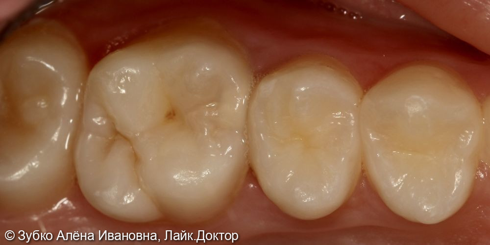 Лечение глубокого кариеса 26 зуба - фото №1