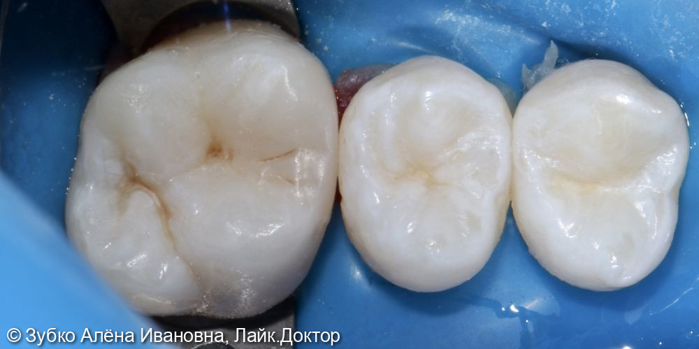Лечение глубокого кариеса 26 зуба - фото №4