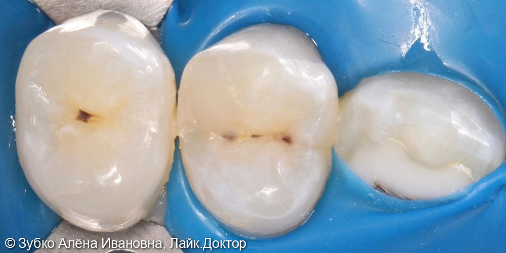 Лечение скрытого кариеса 24 и 25 го зуба - фото №1