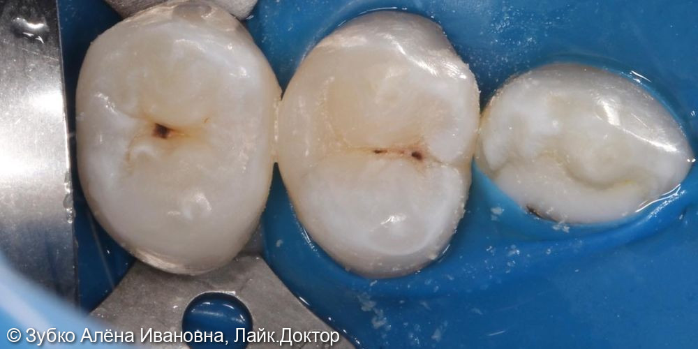 Лечение скрытого кариеса 24 и 25 го зуба - фото №3