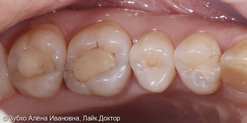 Лечение кариеса 27 26 25 и 24 зубов - фото №1