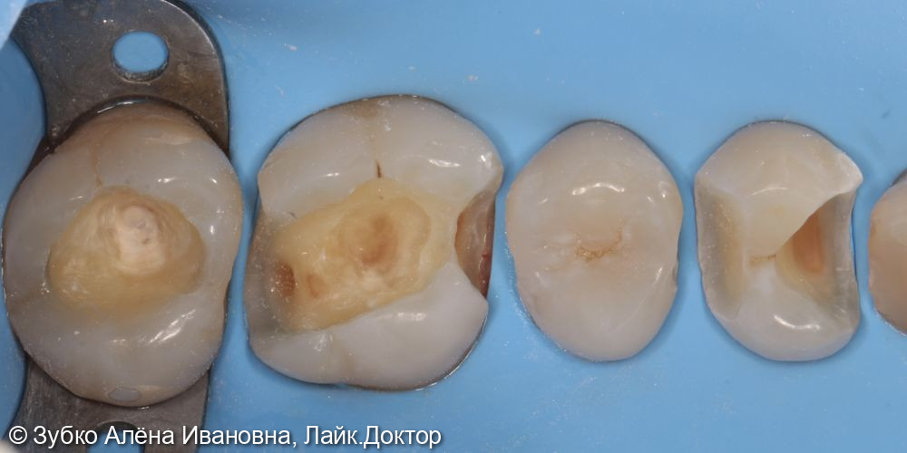 Лечение кариеса 27 26 25 и 24 зубов - фото №2