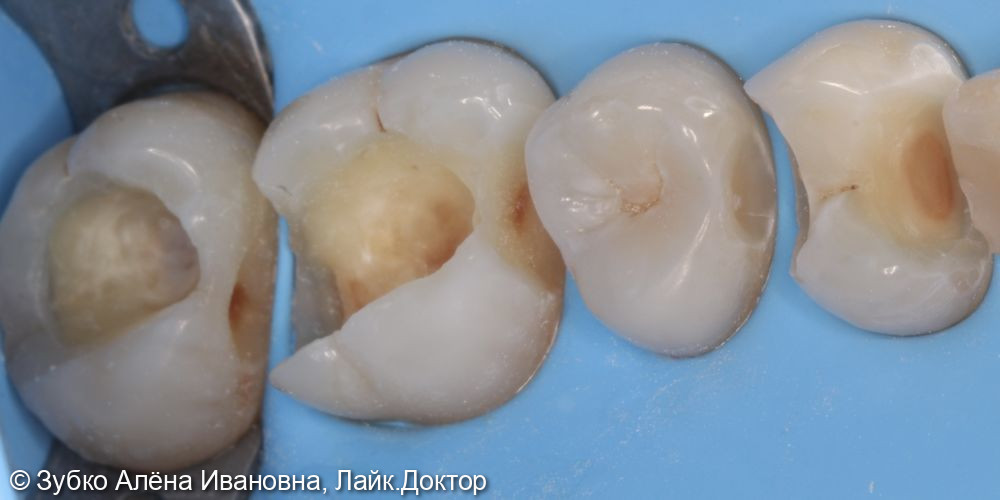 Лечение кариеса 27 26 25 и 24 зубов - фото №4
