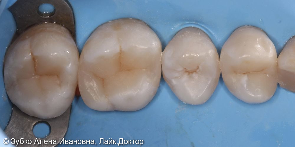 Лечение кариеса 27 26 25 и 24 зубов - фото №5