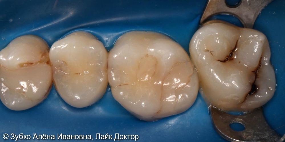 Лечение кариеса 17 16 15 14 зубов - фото №1