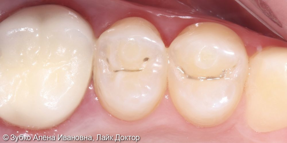 Лечение скрытого кариеса 25 го зуба - фото №1