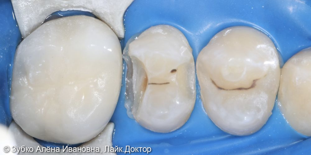 Лечение скрытого кариеса 25 го зуба - фото №2