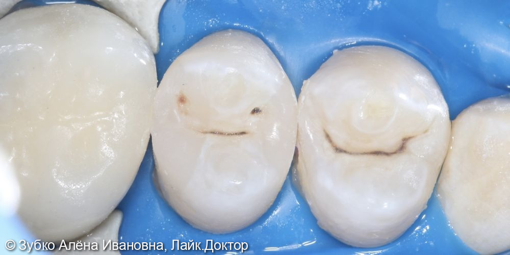 Лечение скрытого кариеса 25 го зуба - фото №3