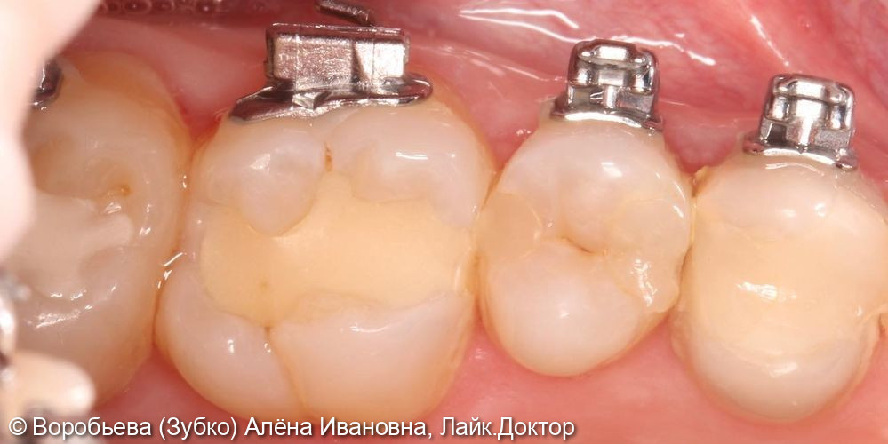 Лечение глубокого кариеса 2.6 и 2.7 зубов - фото №1