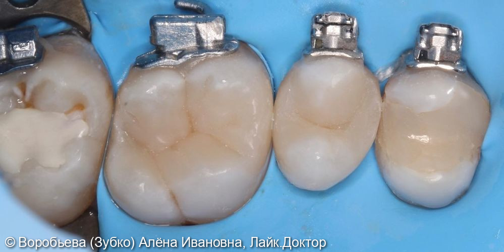 Лечение глубокого кариеса 2.6 и 2.7 зубов - фото №5