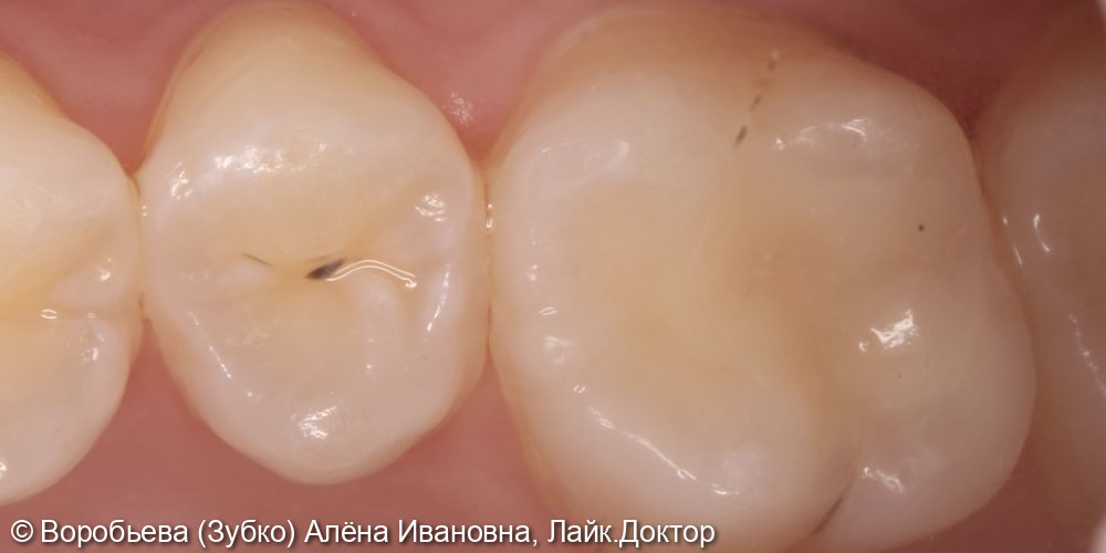 Лечение 14 и 16 го зуба - фото №1
