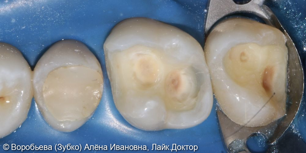 Лечение глубокого кариеса 1.6 и 1.7 зубов - фото №1