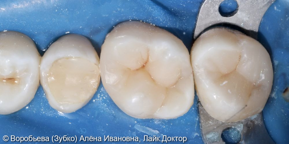Лечение глубокого кариеса 1.6 и 1.7 зубов - фото №3